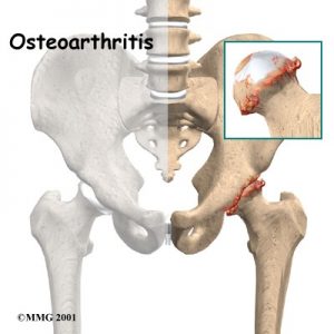 osteopaths liječenje osteoartritisa progesteron i zglobovima