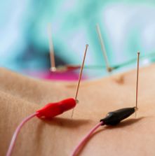 Electroacupuncture Kettering
